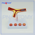 PNT-0725 Modelo de arteriosclerose com trombo para venda